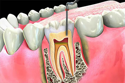 ما لم يخبركم به أطباء الأسنان عن فتح الأسنان والأضراس والأمراض التي تنتج عنها