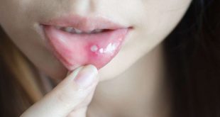 علاج تقرحات الفم واللثة