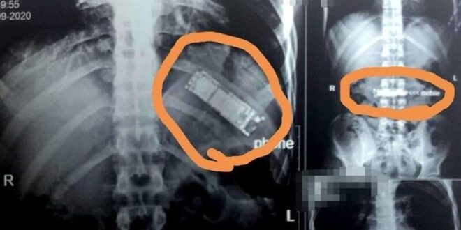 استخراج هاتف محمول من معدة شاب مصري بعد 7 أشهر من ابتلاعه!