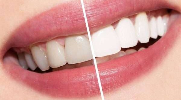 كيفية تبييض الاسنان بالليزر وهل له أضرار؟