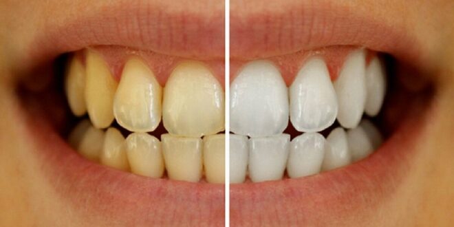 تغليف الأسنان.. نصائح مهمة من المختصين حول الفوائد المذهلة للعملية