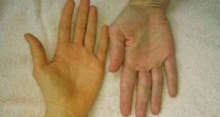 لماذا قد يتغير لون اليدين؟. ما الأسباب المحتملة لحدوث ذلك؟