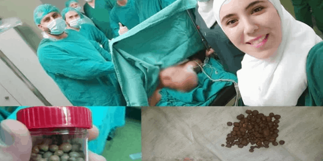 استخراج ١٨٠ حصاة من مثانة مريض خلال عمل جراحي في مشفى الاسد الجامعي بدمشق