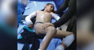 بتوجيه من الرئيس الأسد.. نقل الطفل الذي صعقته الكهرباء بطرطوس إلى مشفى تشرين