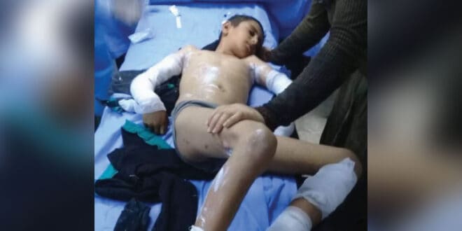 بتوجيه من الرئيس الأسد.. نقل الطفل الذي صعقته الكهرباء بطرطوس إلى مشفى تشرين