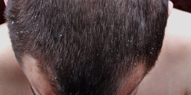 هل تعاني من قشرة الشعر ؟ إليك طرق طبيعية