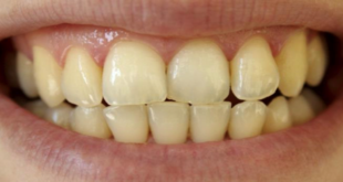 ما هي ابرز اسباب وطرق علاج اصفرار الاسنان المختلفة؟