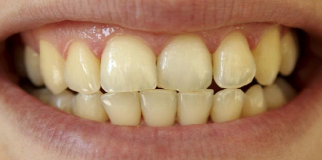 ما هي ابرز اسباب وطرق علاج اصفرار الاسنان المختلفة؟