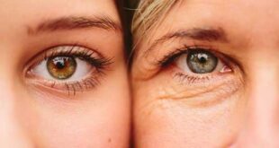 ترهل الجلد حول العينين الأسباب وطرق العلاج