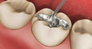 احذر المادة الداخلة في صناعة حشوات الأسنان …مادة سامة