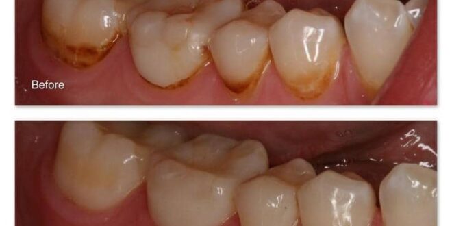 كيف تتخلص من البقع البنية على الأسنان