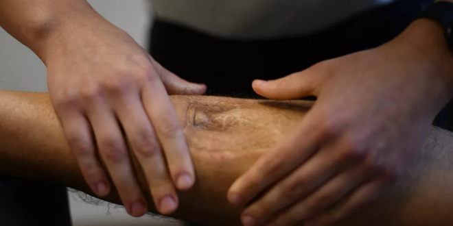 5 أعراض لـ "الموت الصامت" في الساقين يحذر منها العلماء