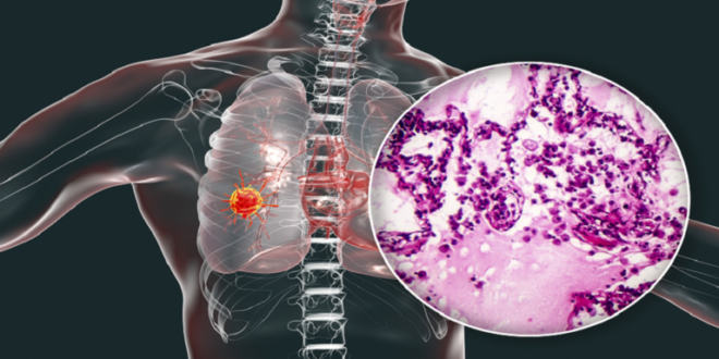 مخاطر إصابتك بسرطان الرئة