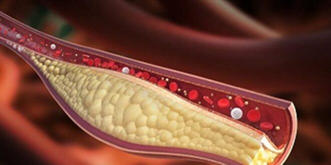 علامتان في وجهك تشيران إلى ارتفاع مستوى الكوليسترول
