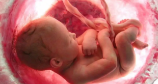 ولادة طفلة وبداخل بطنها جنين.. حالة نادرة أذهلت الأطباء