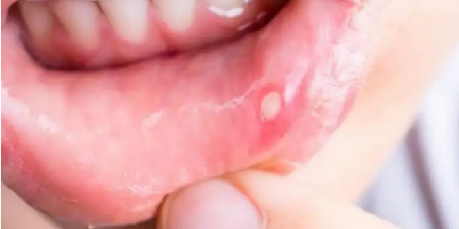 4 علامات في الفم تحذرك من نقص شديد في فيتامين ب 12