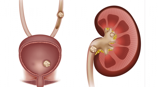 علاج حصوات الكلى بأعشاب وأطعمة طبيعية