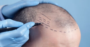 مراحل زراعة الشعر وأهم التعليمات والنصائح