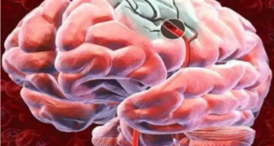 خبراء يكشفون علامة تتنبأ بحدوث النزيف الدماغي