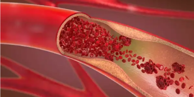 4 عوامل تحافظ على صحة الشرايين