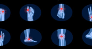 أسباب وجع مفاصل اليدين والرجلين