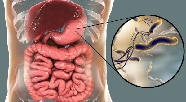 علاج جرثومة المعدة بالأعشاب الطبيعية