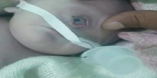 اليمن تشهد ولادة طفل ” بعين واحدة “
