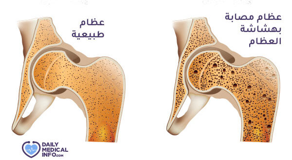 5 طرق لعلاج هشاشة العظام ونصائح تحميك من خطر الإصابة