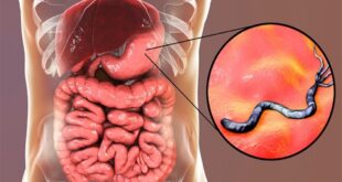 جرثومة المعدة: 8 أعراض تكشفها وأهم التحاليل المطلوبة