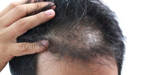 علاج فراغات الشعر بطرق مختلفة اكتشفها!