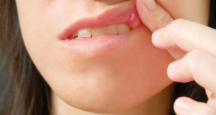 علاجات منزلية فعالة للتخلص من تقرحات الفم