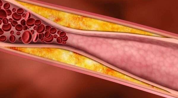 اسباب تصلب الشرايين
