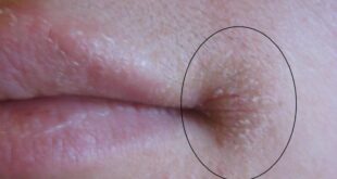 تشققات زوايا الفم تشير إلى مرض خطير