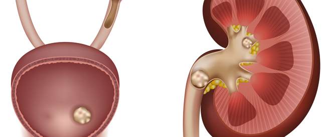 اعراض حصى الكلى وكيفية علاجها