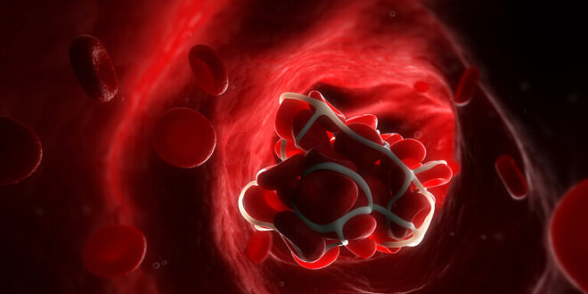تمنع الدم من الحركة" وتسبب جلطات دموية خطيرة