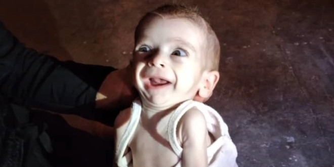 تعاني من فتحة في سقف الحلق! الطفلة السورية “يقين
