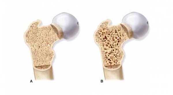 هشاشة العظام والسكري