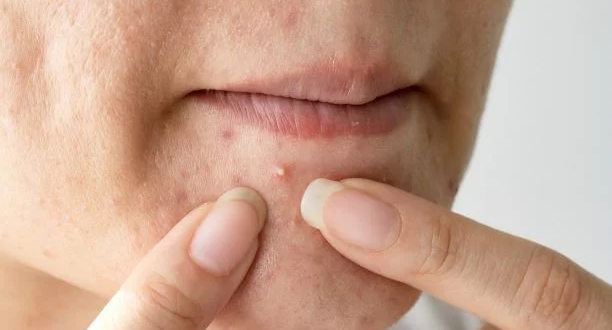 أسباب ظهور الحبوب الدهنية في الوجه