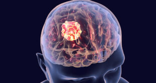 خمسة أعراض تشير إلى مرض خطير في الدماغ