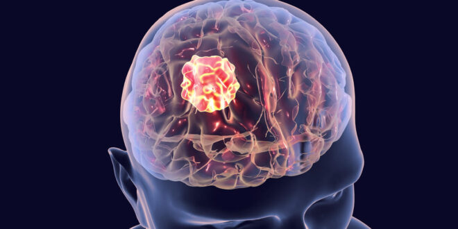 خمسة أعراض تشير إلى مرض خطير في الدماغ