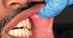 طبيب أسنان يحذر من علامات أربع لسرطان الفم