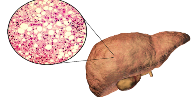 مرض الكبد الدهني