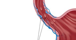 أعراض دوالي المعدة وأسبابها وعلاجها