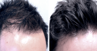 فيلر الشعر لعلاج تساقط الشعر وفراغات الرأس