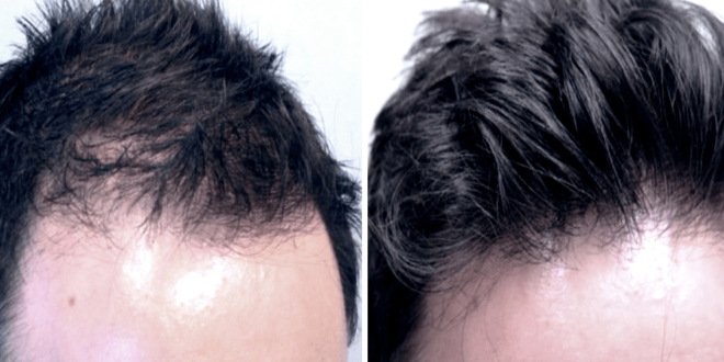 فيلر الشعر لعلاج تساقط الشعر وفراغات الرأس