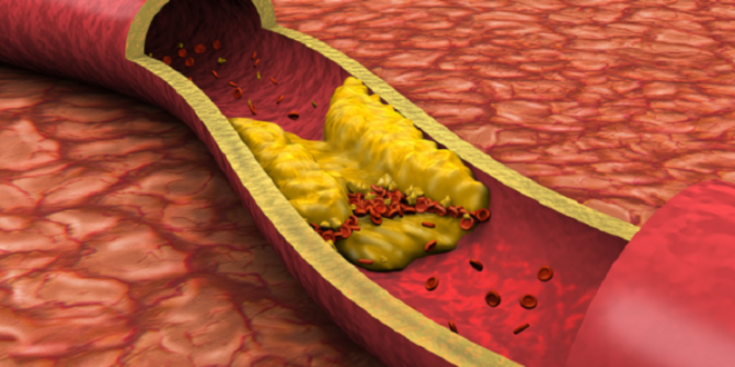 دراسة جديدة: حبوب شائعة يمكن أن تخفض نسبة الكوليسترول بنسبة 70٪