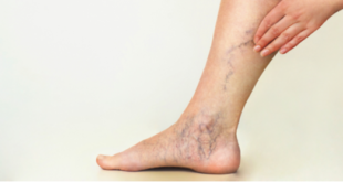 دوالي الساقين Varicose veins: الأعراض والأسباب والعلاج