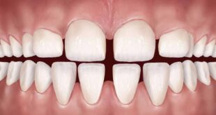 علاج تفرق الأسنان