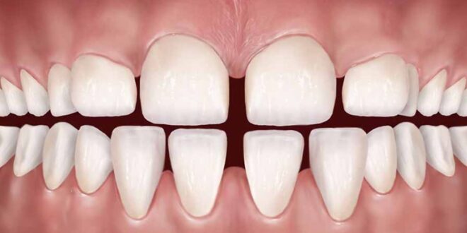 علاج تفرق الأسنان