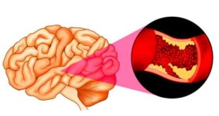 اعراض الجلطة الدماغية التي يجب الانتباه لها